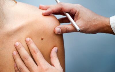 ITUZAINGÓ: CAMPAÑA DE PREVENCIÓN DEL CÁNCER DE PIEL