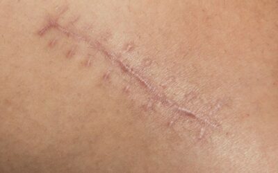 CIENTÍFICOS PRODUCEN PIEL HUMANA PARA CURAR HERIDAS